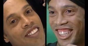 Chirurgie esthétique: Ronaldinho avant et après