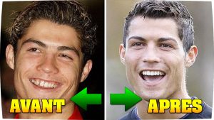 Chirurgie esthétique: Cristiano Ronaldo avant et après